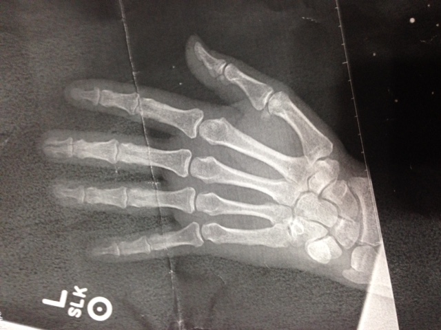 Check out the black line that runs the length of bone in the tip of my middle finger and into the joint.  The technical term for this is a "Social Finger" crushing fracture of the distal phalange.  You can achieve this many ways but mine is from dropping the rear axle off jack stands on my welding bench.  Had this same injury happen to my thumb 35-years ago.  I guess I just didn't learn from that experience.  My tip to others: Try to avoid this whenever possible.