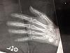 Check out the black line that runs the length of bone in the tip of my middle finger and into the joint.  The technical term for this is a "Social...